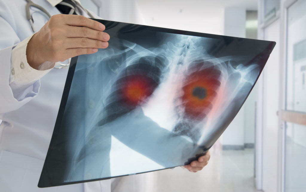 Australian lung disease claims x-ray
