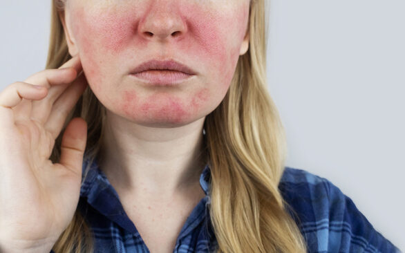 Australian woman with lupus lesions