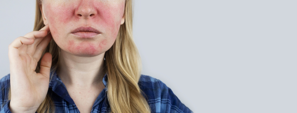 Australian woman with lupus lesions