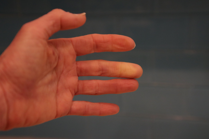 hand with lupus lesions