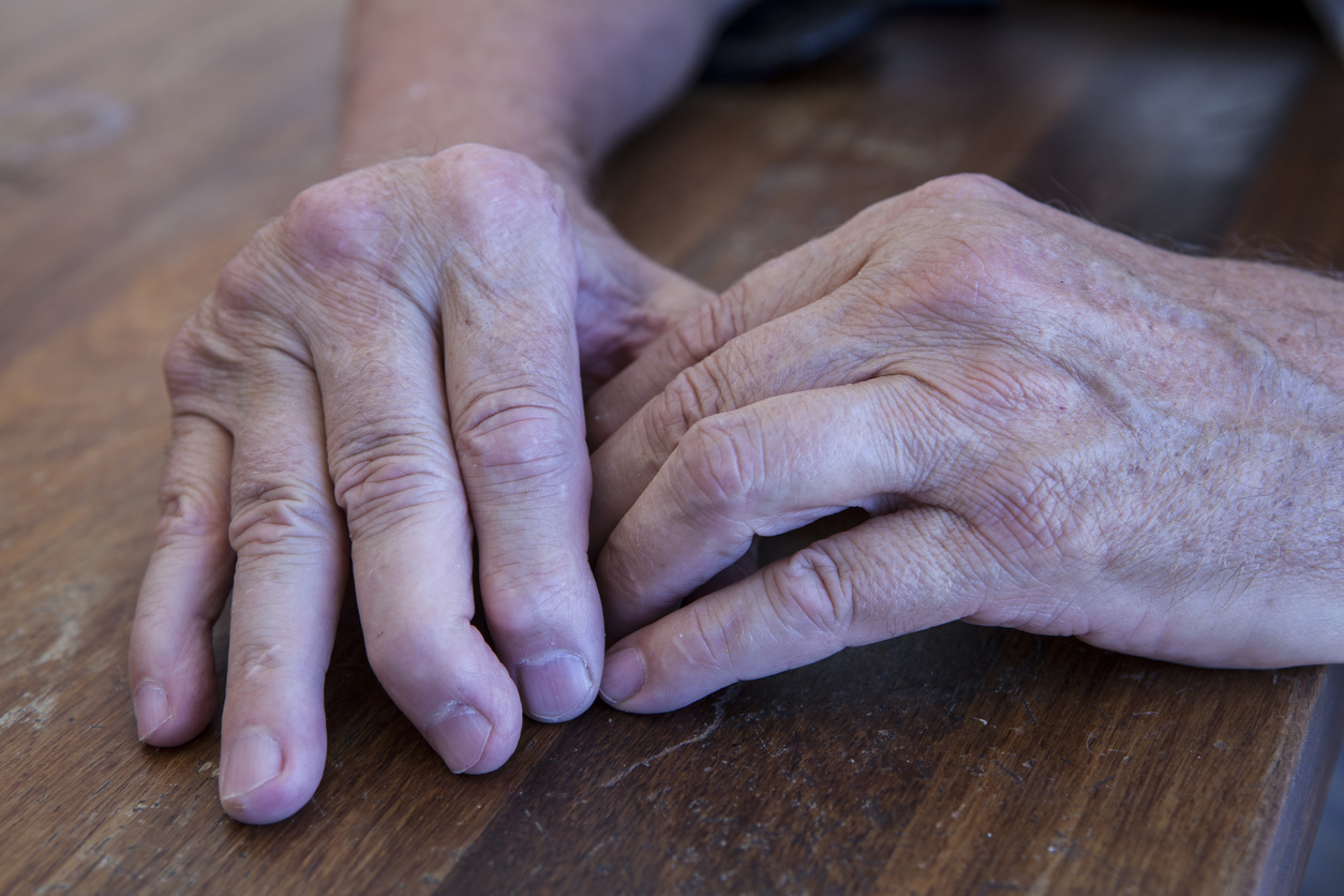 arthritis and other autoimmune diseases can force you to stop working